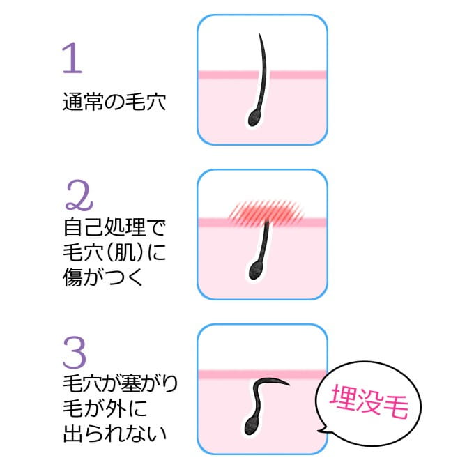 ブラジリアンワックスは痛いけど即効 効果とデメリット 脱毛デレラ